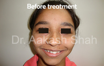 Aakash orthodontics Latest Cases