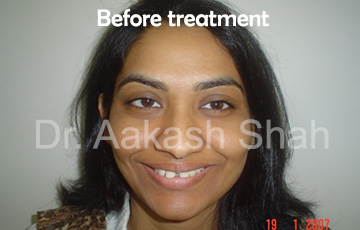 Aakash orthodontics Latest Cases
